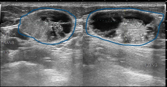 Thyroid ultrasound identifying nodules and helping determine the need for fine-needle aspiration Thyroid ultrasound identifying nodules and helping determine the need for fine-needle aspiration